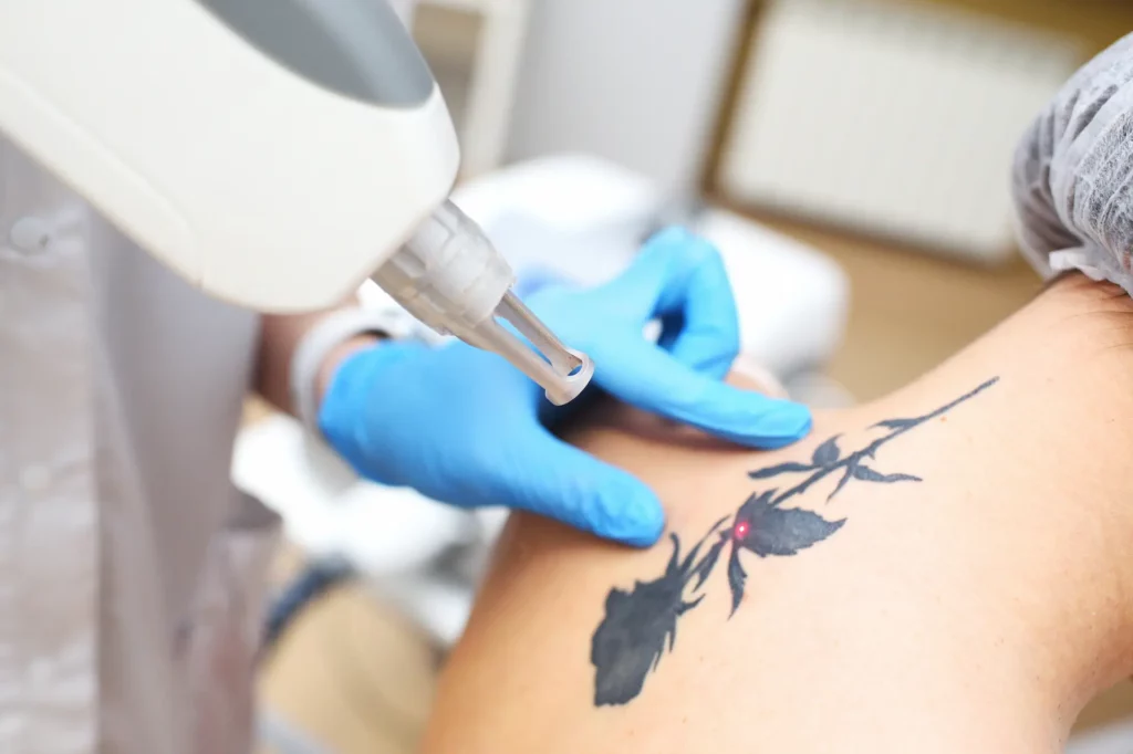 Laser tattoo removal