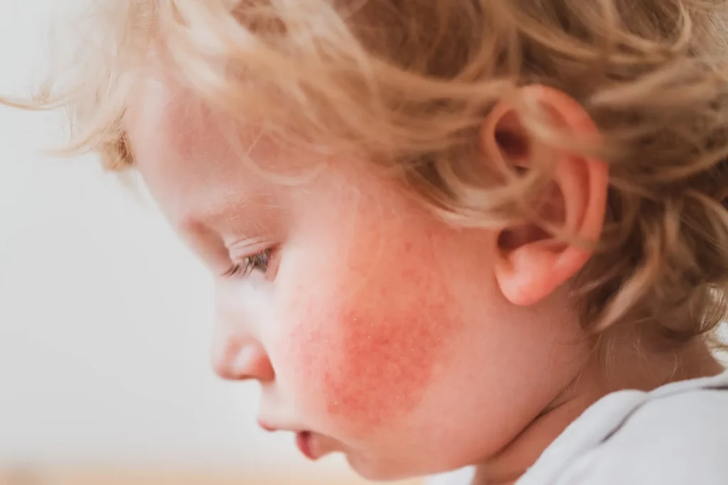 Young child with eczema