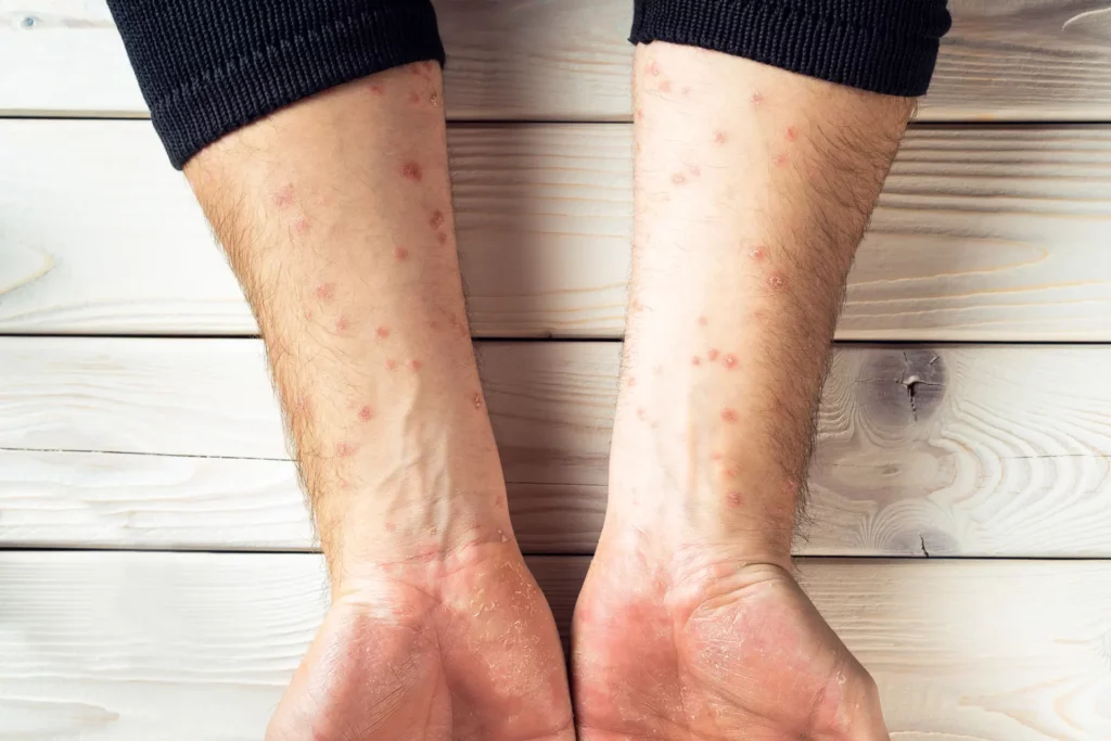 Psoriasis on the arms improving with psoriasis management